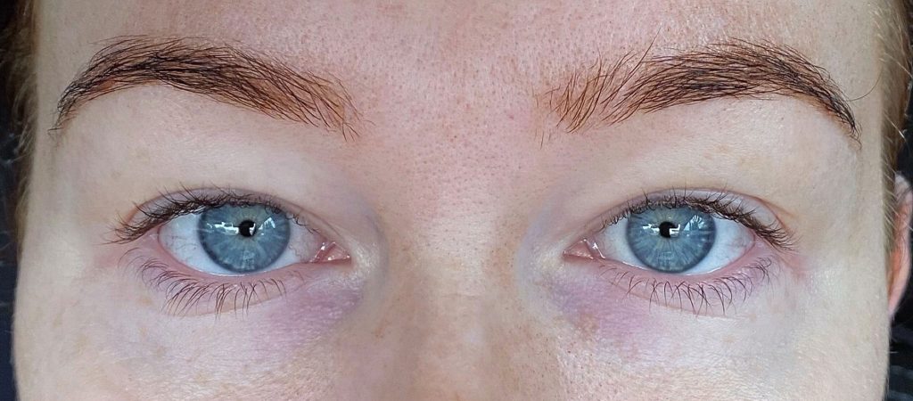 Upper eyelid reduction 1a, cosmetic surgery, signature clinic, blepharoplasty, eyelid reduction, upper eyelid reduction