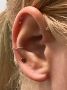 Earlobe-Repair-After, cosmetic surgery, signature clinic
