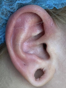Earlobe-Repair-before, cosmetic surgery, signature clinic