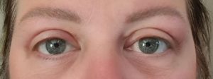 blepharoplasty after- signature clinic 1