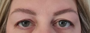 blepharoplasty before- signature clinic 1
