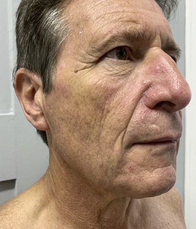Necklift, necklift UK, necklift london, necklift surgery, Platysmaplasty