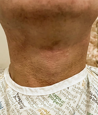 Necklift, necklift UK, necklift london, necklift surgery, Platysmaplasty