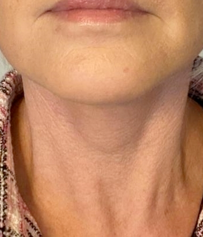 Necklift, necklift UK, necklift london, necklift surgery, Platysmaplasty