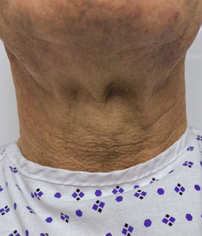 Necklift, necklift UK, necklift london, necklift surgery, Platysmaplasty