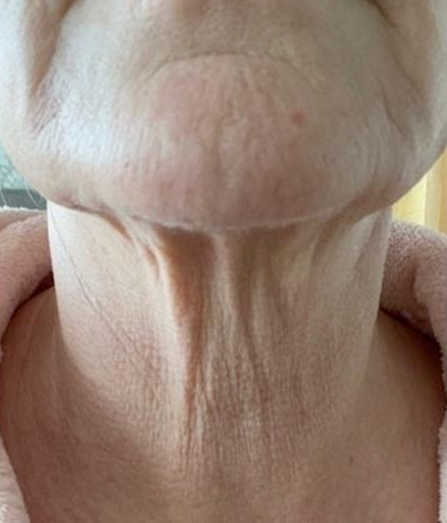 Necklift, necklift UK, necklift london, necklift surgery, Platysmaplasty