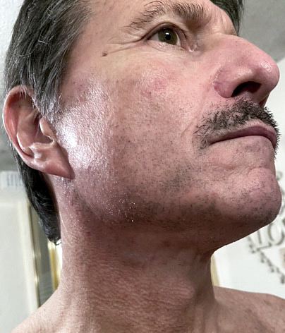 Necklift, necklift UK, necklift london, necklift surgery, Platysmaplasty