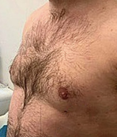 gynecomastia