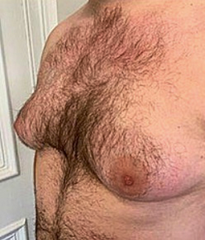 gynecomastia