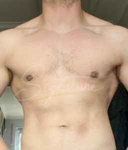 gynecomastia