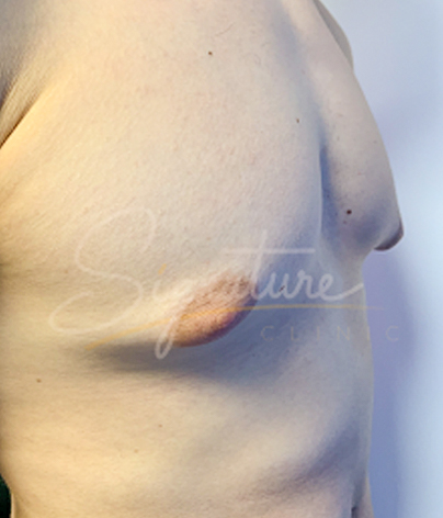 gynecomastia