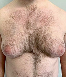 gynecomastia