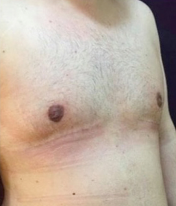 gynecomastia after treatment