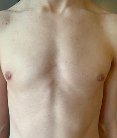 gynecomastia