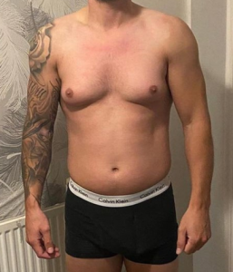 gynecomastia before