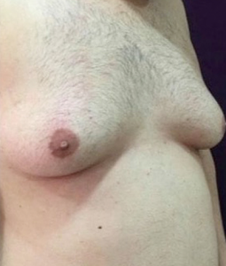 gynecomastia before treatment