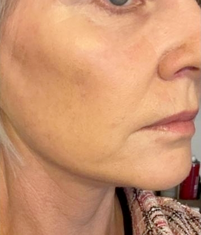 Patient side facing headshot after a facelift