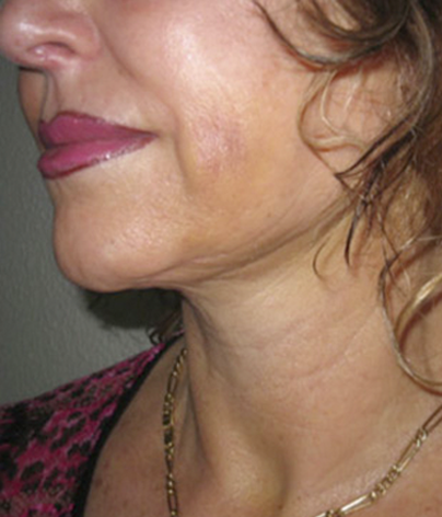 Patient side facing headshot after a facelift