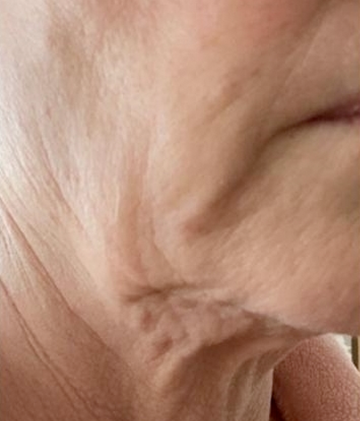 Patient side facing headshot before a facelift