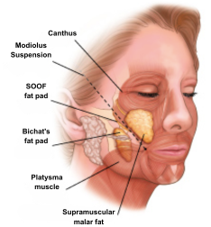 Buccal Fat Removal