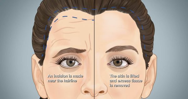 brow lift surgery