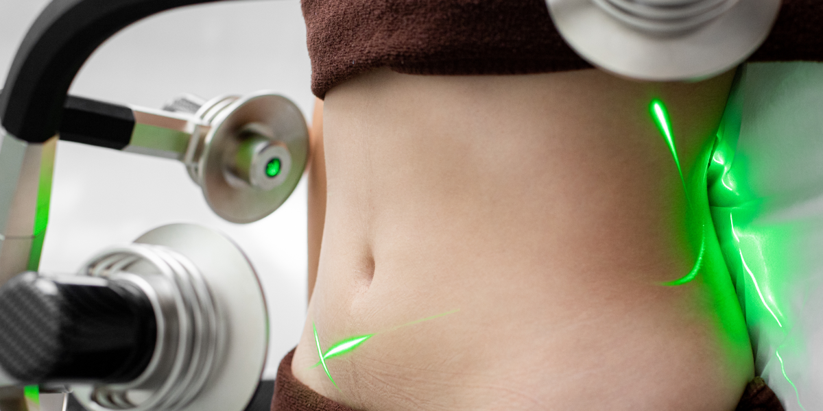 emerald laser lipo