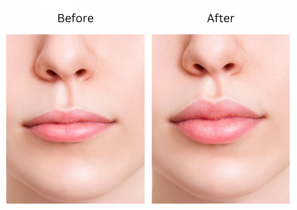 Lip augmentation
