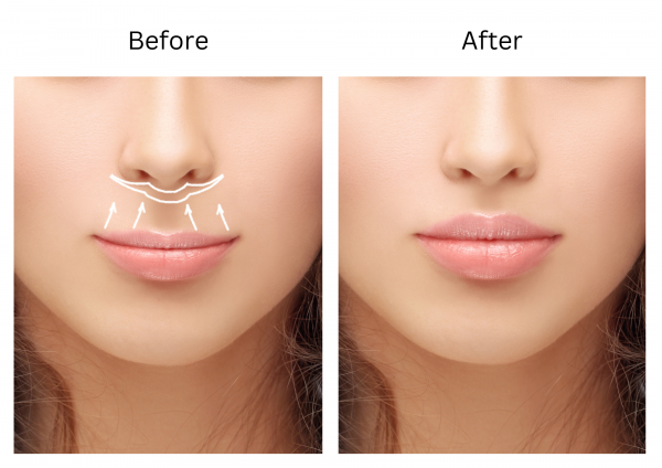 lip lift