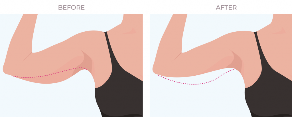 Arm lift, brachioplasty