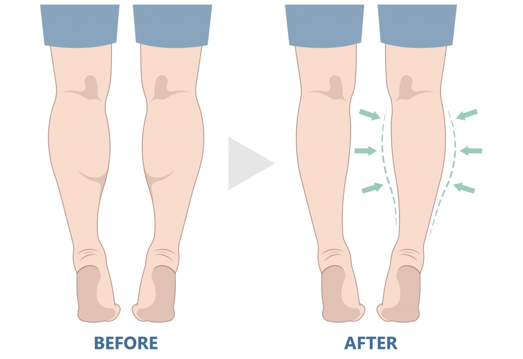 Calf reduction
